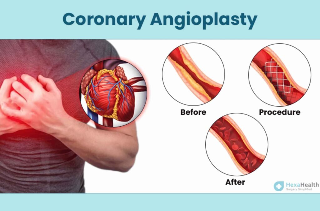 Coronary Angioplasty