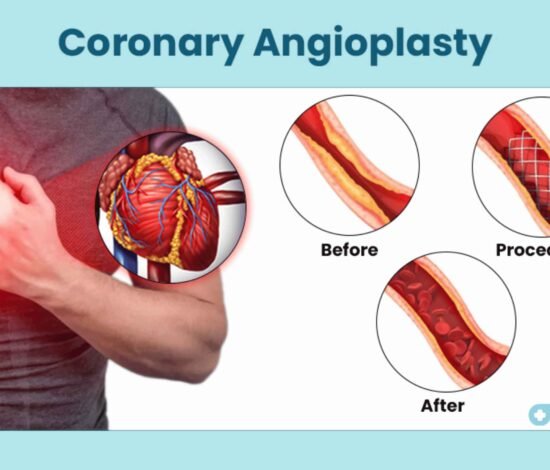 Coronary Angioplasty