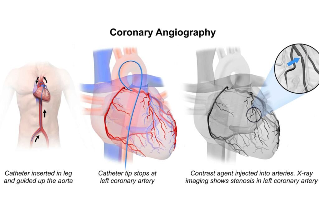 Coronary Angiography