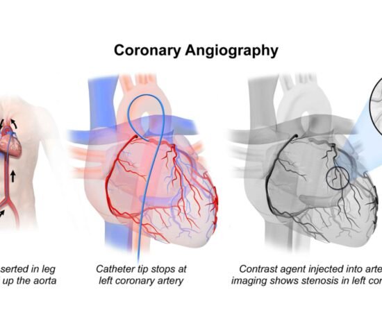 Coronary Angiography