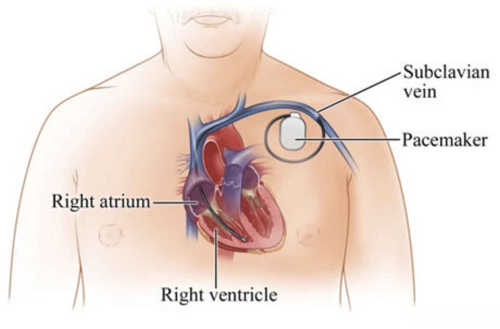 Permanent Pacemaker