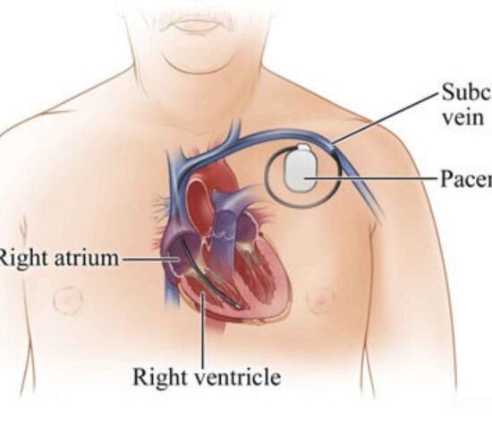 Permanent Pacemaker