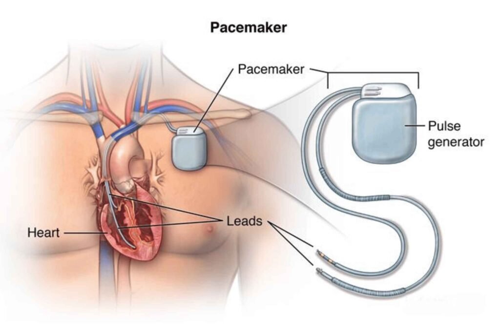 Temporary Pacemaker