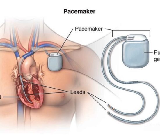 Temporary Pacemaker