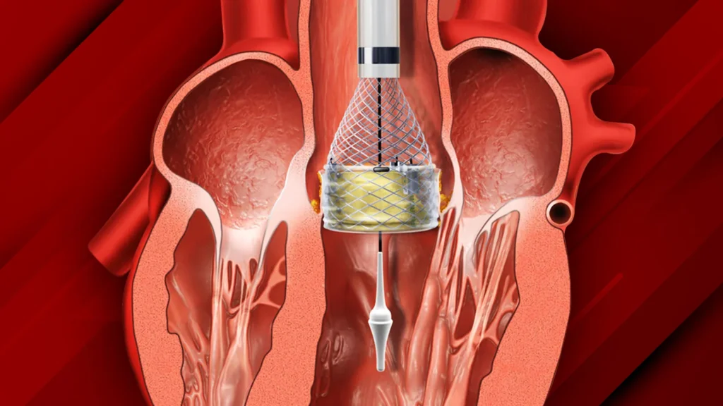 TAVI-Procedure-A-Boon-for-Critical-Heart-Patients-during-the-Pandemic