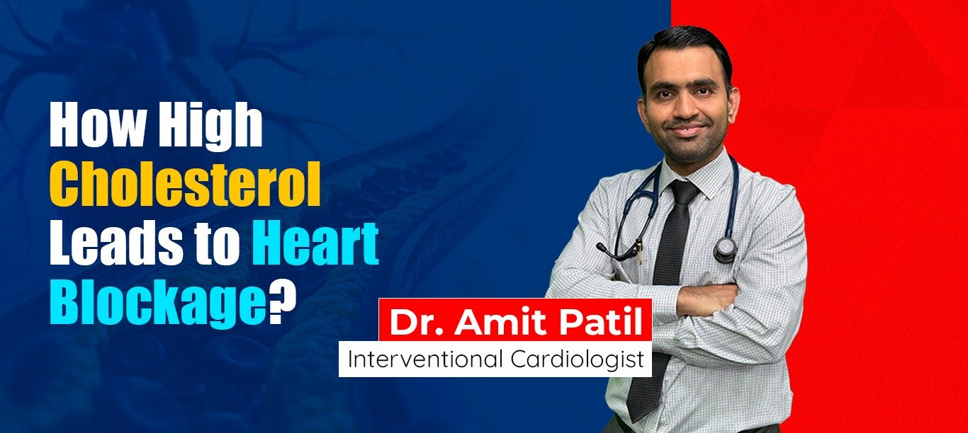How High Cholesterol Leads to Heart Blockage
